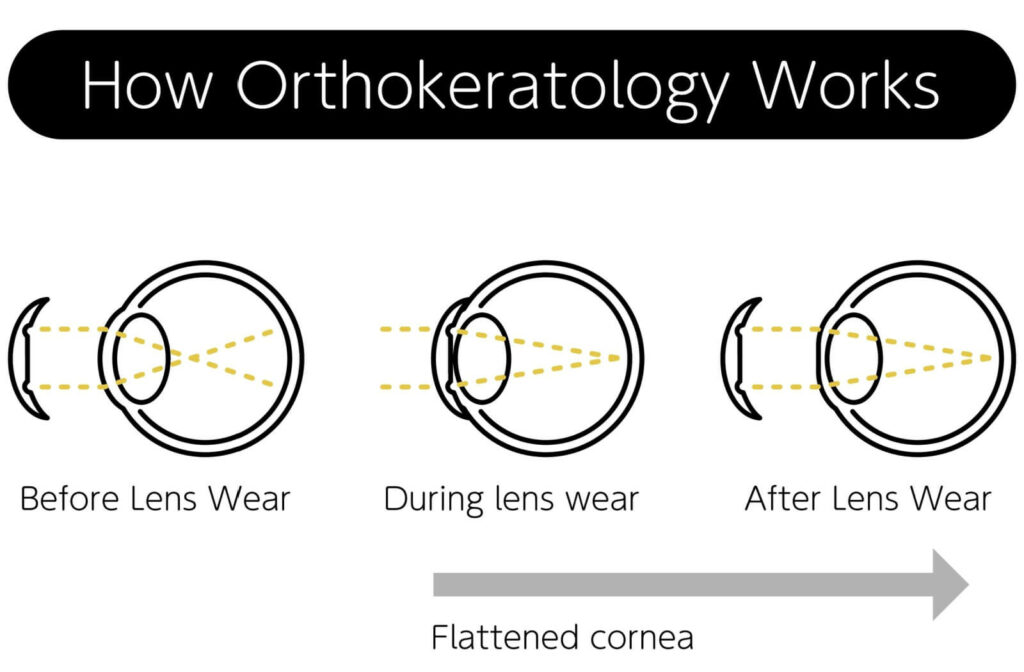A diagram of how orthokeratology works from before wearing it, during leans wear, and after lens wear.