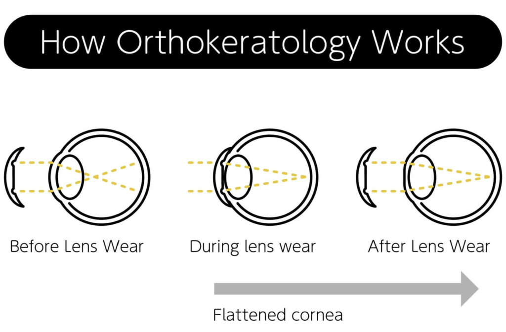 OrthoK Lenses Everything You Need to Know Plainville