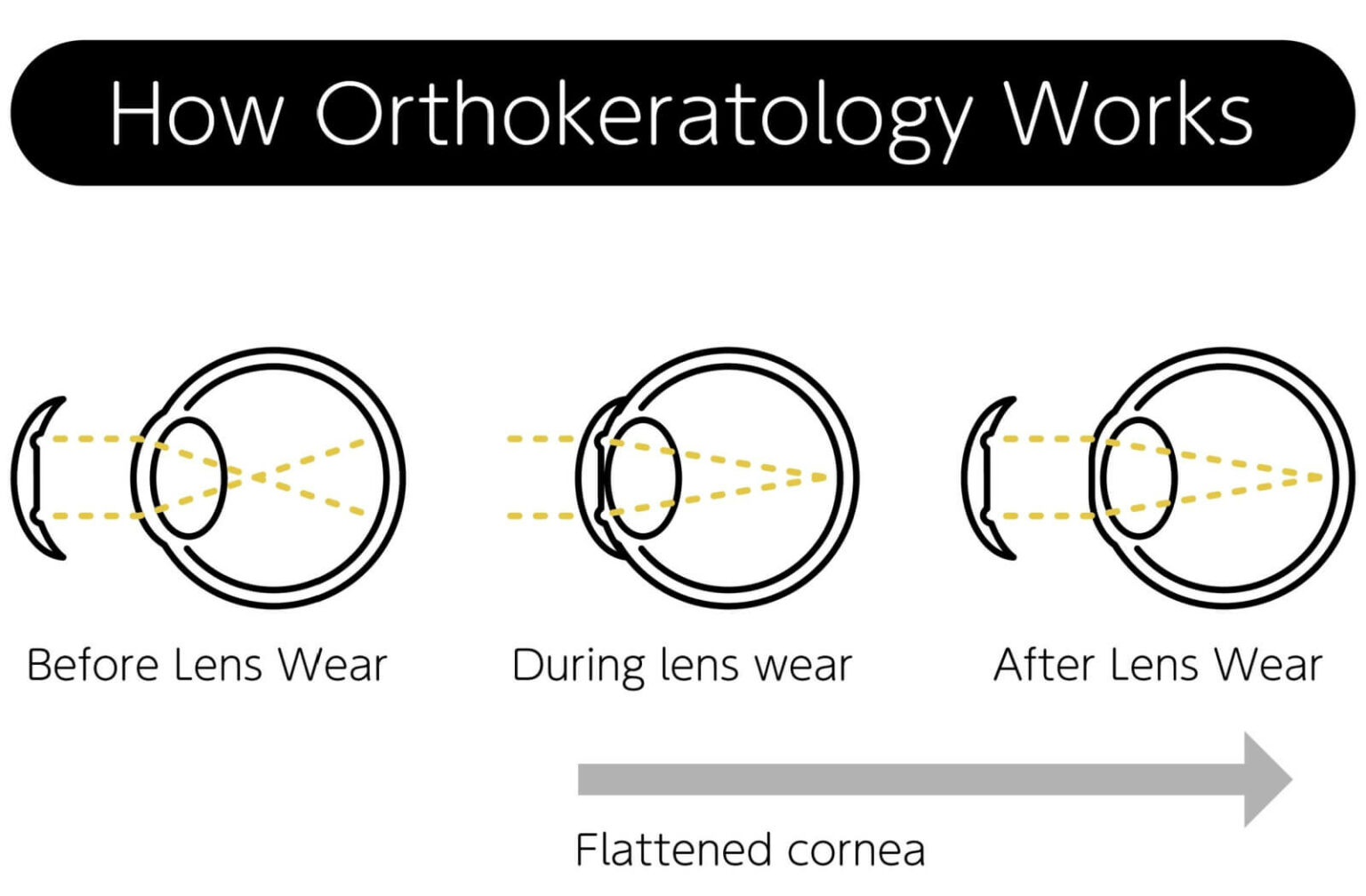 Ortho-K Lenses: Everything You Need to Know | Plainville