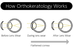 Ortho-K Lenses: Everything You Need to Know | Plainville