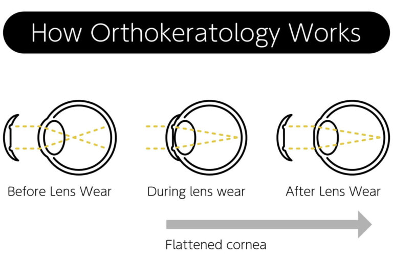 Ortho k lenses near me