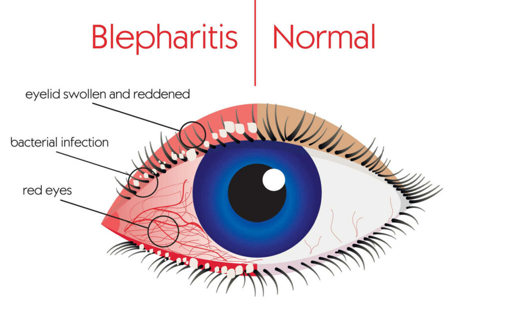 A comparison between a normal eye and an eye affected with blepharitis to show all symptoms of blepharitis.