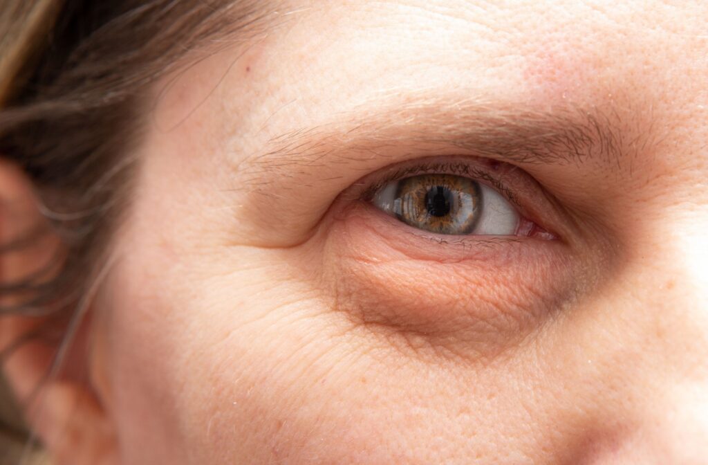 Close-up of a person's eye showing hooded eyelids, highlighting the natural appearance of this condition.