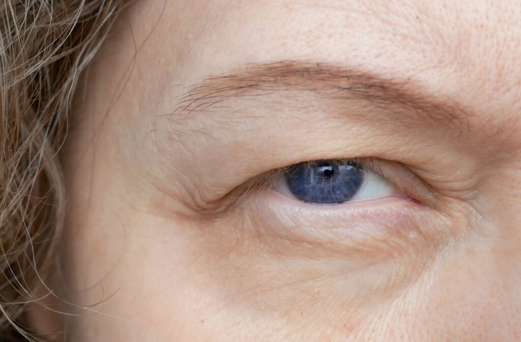 A close up of a person with droopy eyelid.